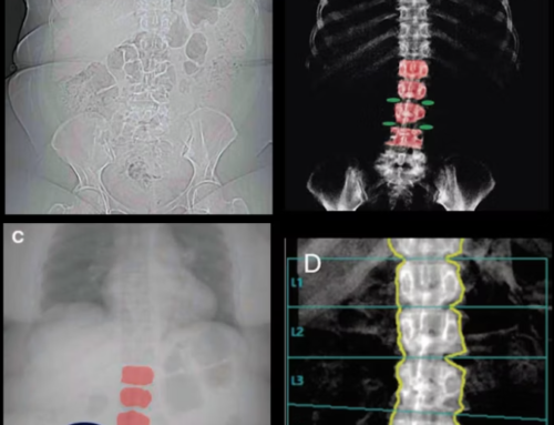 Photon-counting CT may screen for low bone density